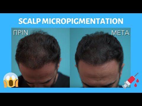 👉Τατουάζ στα ΜΑΛΛΙΑ?!?!-Scalp Micropigmentation - Ιατρικό τατουάζ😱🤔Anastasakis Hair Clinic