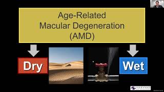 Age-related Macular Degeneration (AMD) 2023