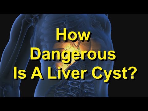 Video: Liver Cyst: Causes, Treatment, Why Is It Dangerous
