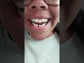 WATCH THIS BRACES TRANSFORMATION!! #shorts