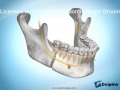 Avancement de la mandibule par chirurgie