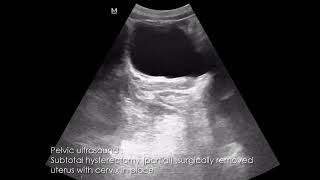CASE 1006 Subtotal hysterectomy,ovarectomy