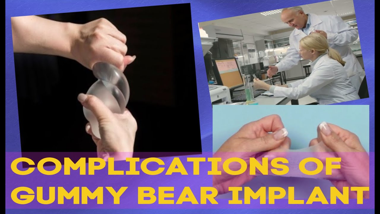 Gummy bear implants by Gummy Bear Implants - Issuu