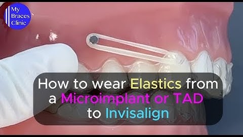 How to wear Elastics from a microimplant or TAD to Invisalign