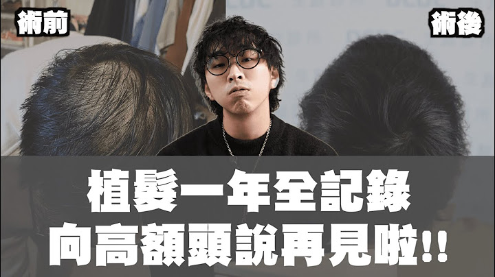 植发手术一年纪录!! 终于可以告别高额头、发量少的日子啦～ | TheShorty  那个矮子 - 天天要闻