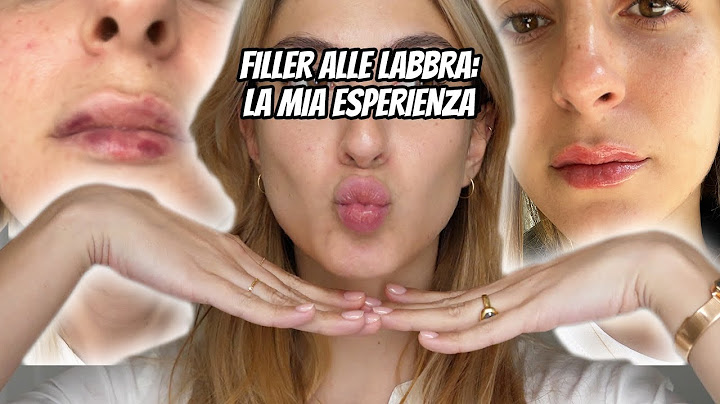HO FATTO IL FILLER ALLE LABBRA E VI RACCONTO TUTTO || LaRetrò