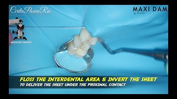 RUBBER DAM PLACEMENT MULTIPLE TEETH ISOLATION PRIOR TO CLASS 2 RESTORATION IN MAXILLARY MOLAR ❗️
