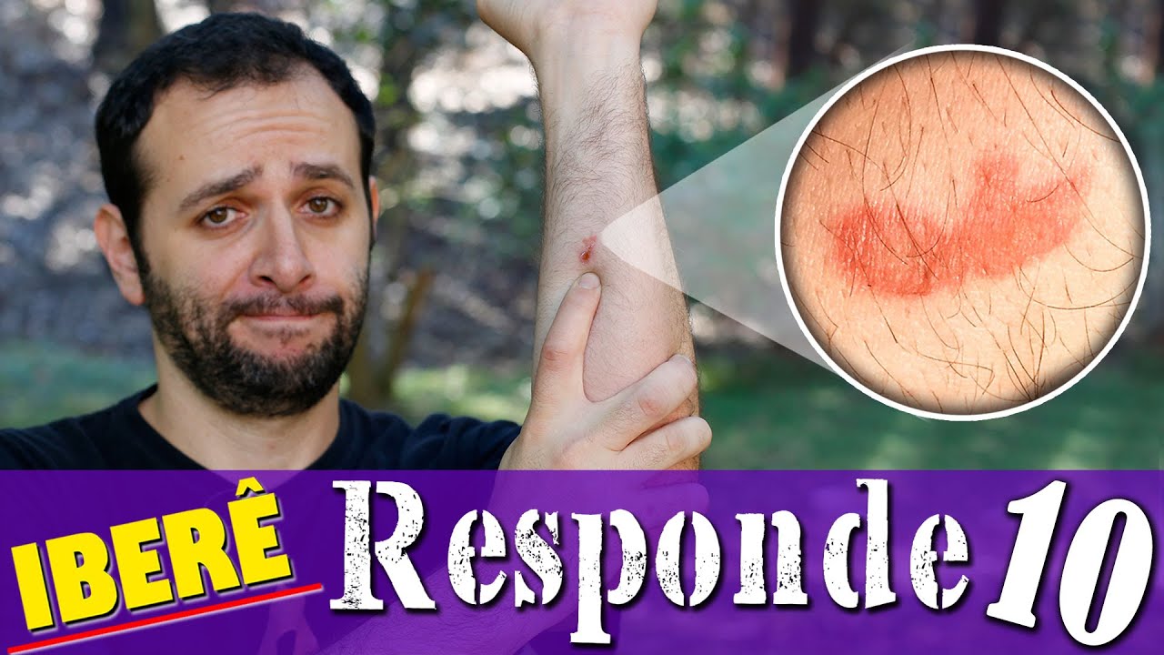 Como queimei o braço com cola quente (respostas cimento) adivinhação dificil