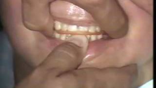 Mounting Partially Edentulous Casts