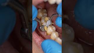 Tartar Wall Breakdown – From Rock-Hard Plaque to Clean SmileHashtags:#dentist