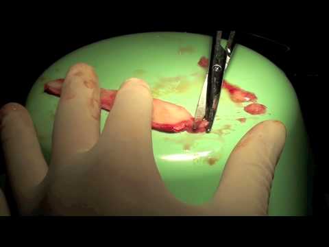 chemotherapy port Skin Graft