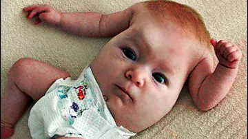 ¿Cuántos bebés nacen sin ojos?