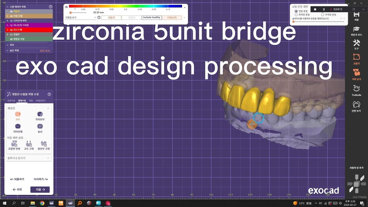 치과에서 의뢰한 zirconia 5unit bridge 제작과정 exo cad를 이용한 design l milling후 ...