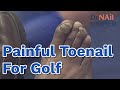 Toenail too Painful for Golf. Warm weather. Honey the Dog. FEET-ure Friday (2022)