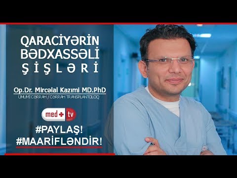 Video: Hepatosellüler karsinoma niyə yaranır?