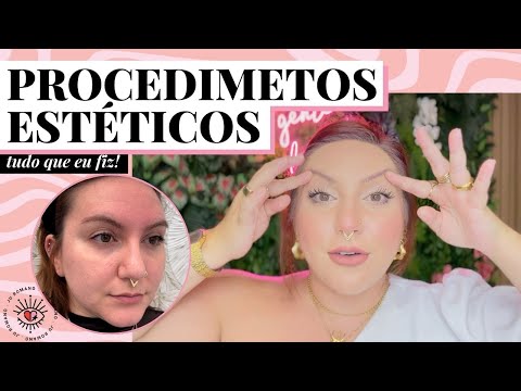 Meus procedimentos estéticos: como ficou o botox preventivo e o preenchimento labial