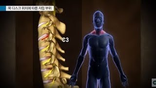 목 디스크 위치에 따른 저림 부위