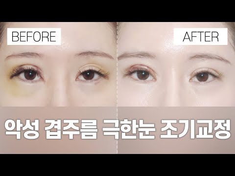 눈 성형 전후 |  악성 겹주름 극한눈 조기교정 일주일 전후