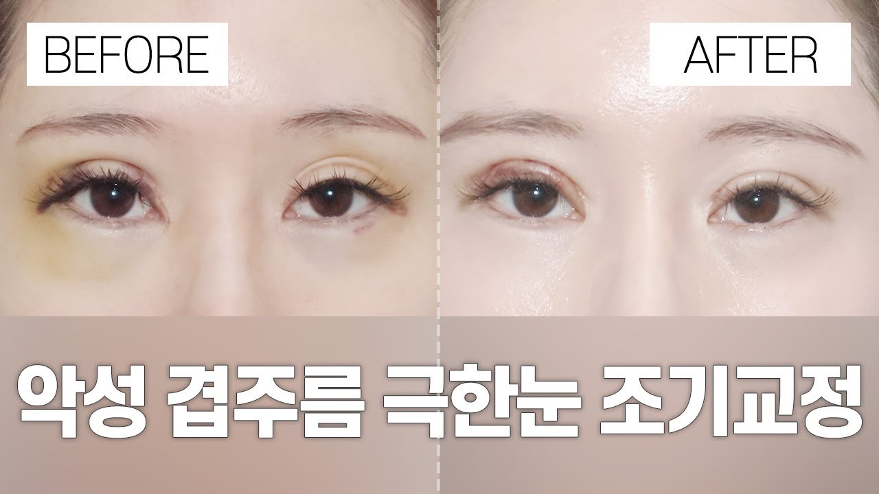 [Ганнам Сэён гоо сайхны мэс заслын эмнэлэг] Нүдний гоо сайхны мэс заслын өмнө ба хойно | Хэт хүнд давхар зовхины эрт засварлалтын нэг долоо хоногийн өмнө ба хойно