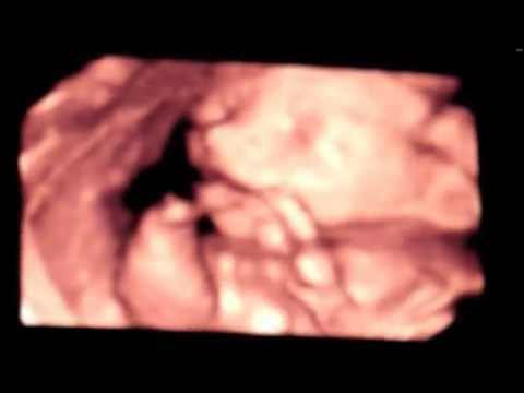 Videó: Sonogram Vs. Ultrahang