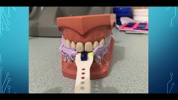 Trios scan for bite for sleep appliance