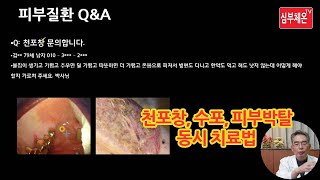 피부 질환 Q&A (36) - 천포창 치료법 및 주의사항
