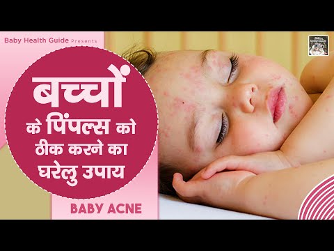 बच्चों के शरीर पर दाने का इलाज | Baby acne in hindi | baby Acne treatment | My baby care