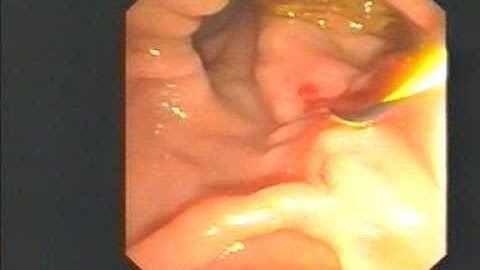 Endoscopy Master Videos: ERCP Cannulation in diverticulum & sphincterotomy @ www.gastroliver.com.sg