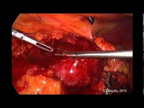 Zero Ischemia Laparoscopic Partial Nephrectomy