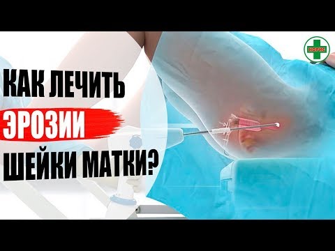 Как избежать рака шейки матки? Как лечить эрозии шейки матки? Лазерное лечение эрозий