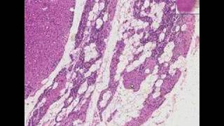 Histopathology Parathyroid--Oxyphil adenoma