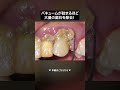 バキュームが詰まるほどの大量の歯石除去‼️