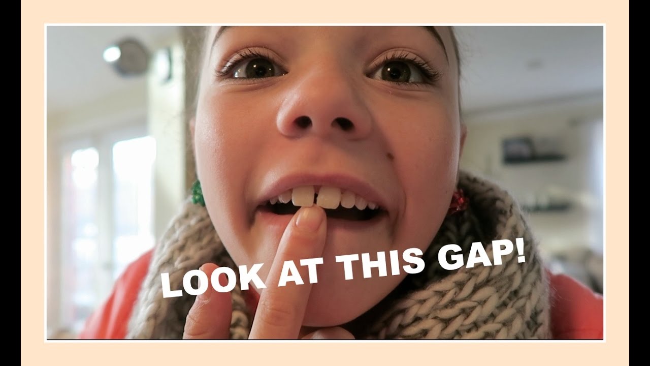 MY TEETH ARE MOVING! READY FOR BRACES? Flippin' Katie YouTube
