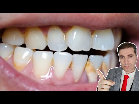 Video: Kako napraviti izbjeljivače zuba: 9 koraka (sa slikama)