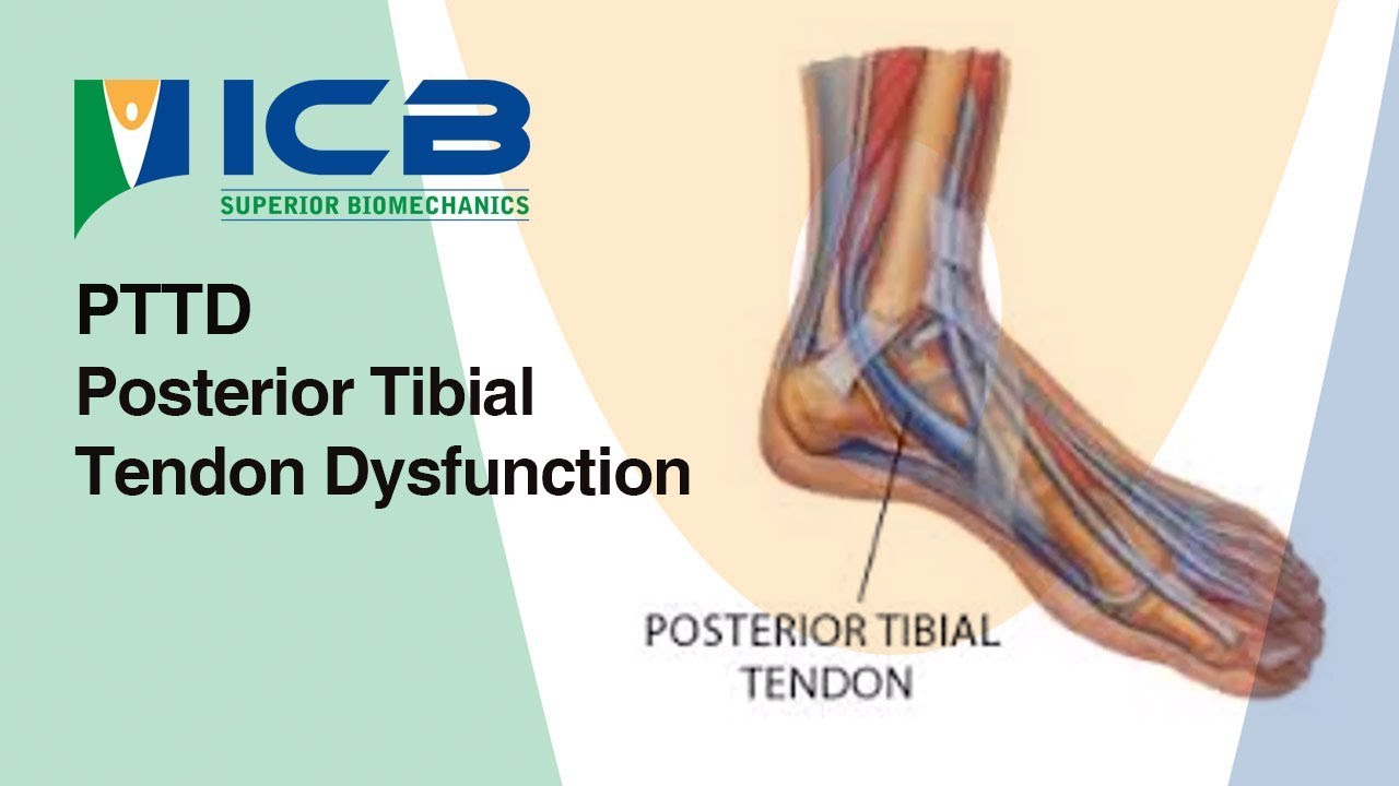 pttd posterior tibial tendon dysfunction posterior tibial tendon dysfunction