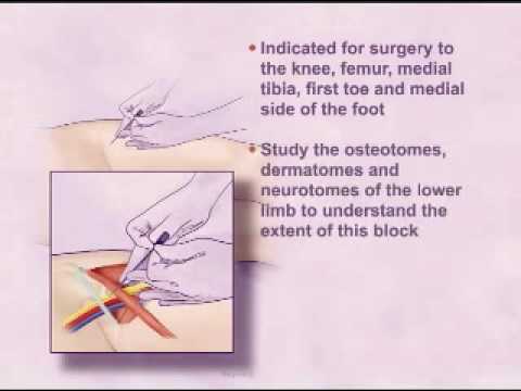 single injection femoral nerve block - youtube single injection femoral nerve block - youtube, Muscles