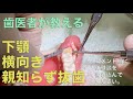 下顎横向き親知らず抜歯　Part３