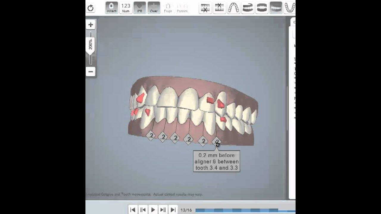 how-invisalign-programs-the-movement-of-your-teeth-during-orthodontic