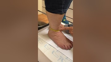 Measuring, outlining and casting for Custom Orthopedic Footwear. Davis Shoe Therapeutics