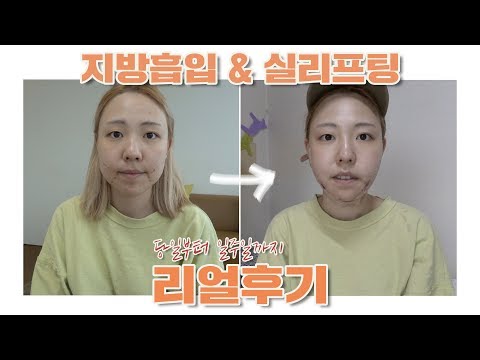 💡쳐진 볼살&amp;amp;이중턱 지방흡입, <strong>실리프팅</strong> 리얼후기(당일부터 일주일차까지)💡 #당일효과 #<strong>붓기</strong> #통증 | GONGSIL 공실이