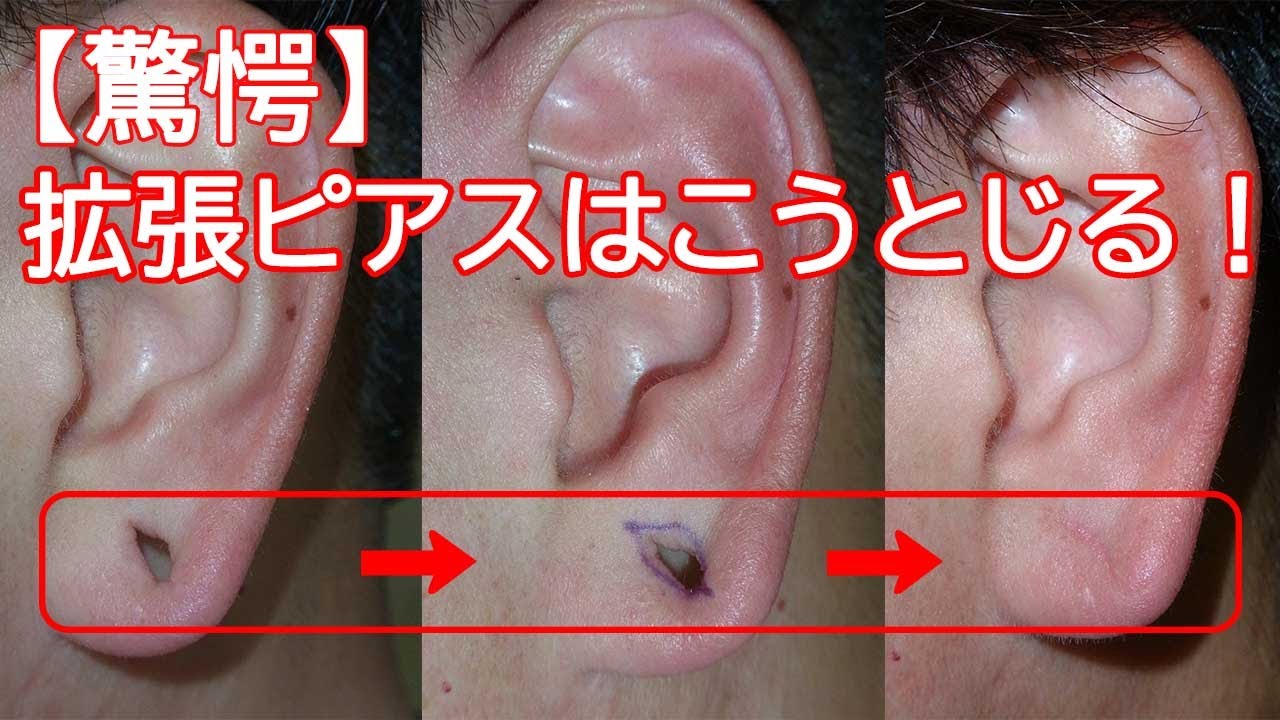 ピアス の 跡