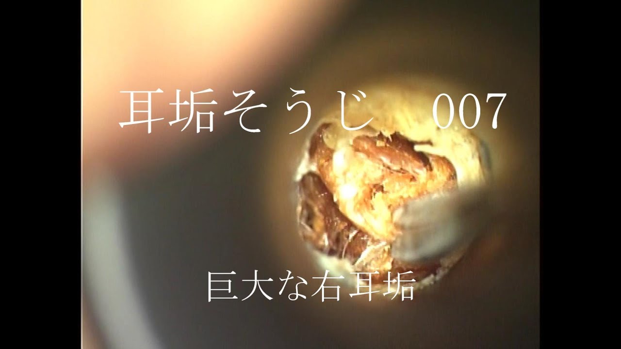 耳垢そうじ/難聴を伴う巨大な右耳垢/007 - YouTube