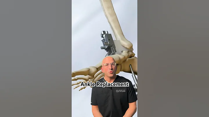 Why Are Artificial Ankle So Rare⁉️ #shorts