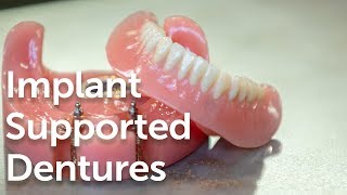 Implant supported dentures explained