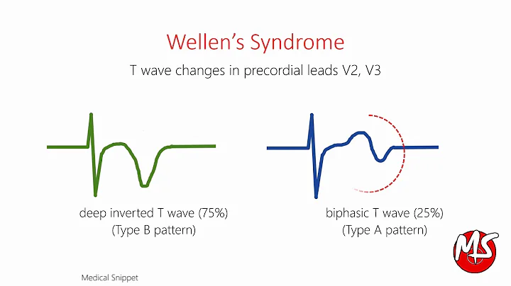 Wellens Syndrome with ECG and Angiography example