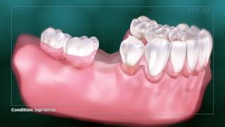 Single Tooth Loss