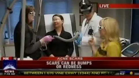 Fraxel & Perfecta/Smoothbeam Laser treatments with Dr. Eric Bernstein