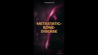 Mirels Score Explained: When to Fix Metastatic Bone Disease