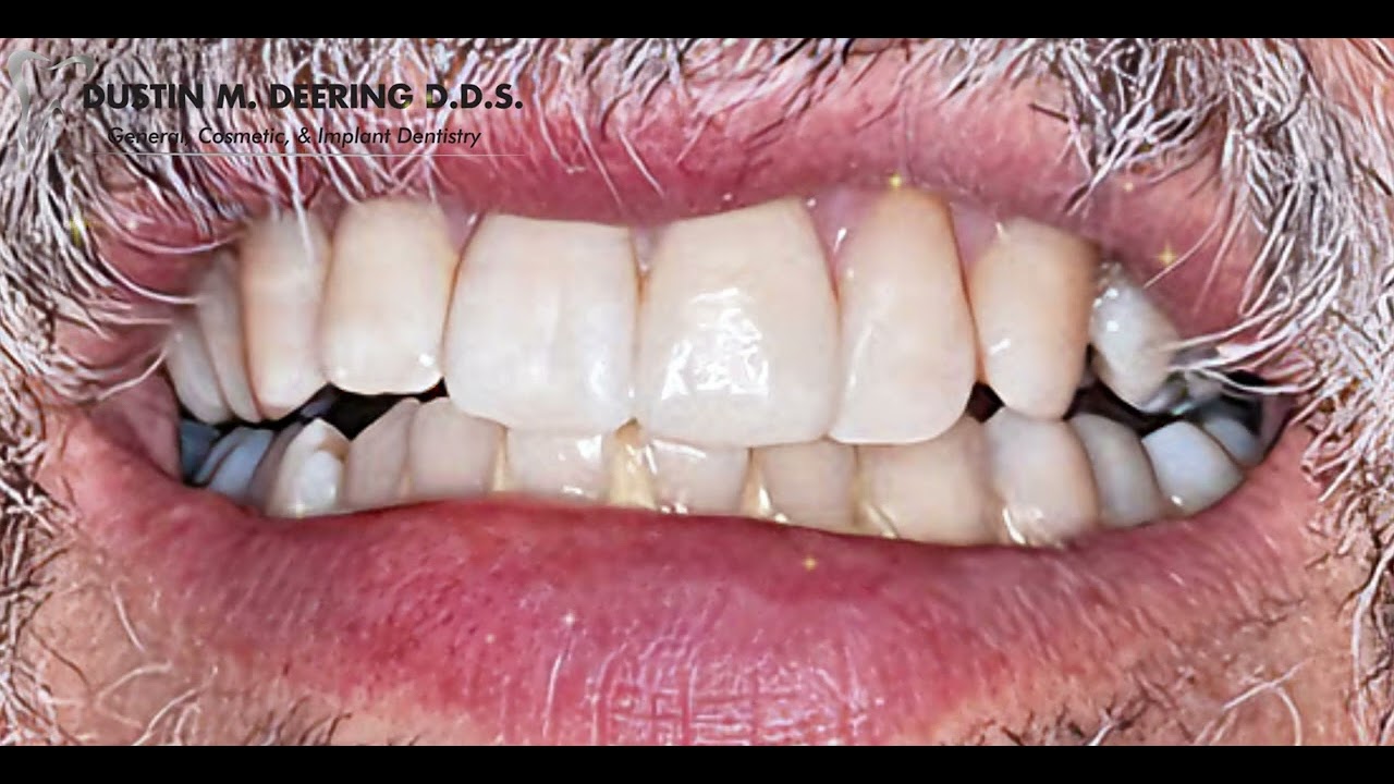 Transform Your Smile with Dr. Dustin Deering, DDS in Encinitas!