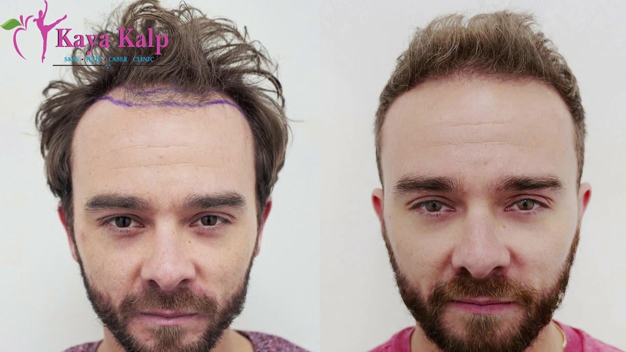 What is the best treatment for hair loss ? By Dr. Piyush Borkhatariya